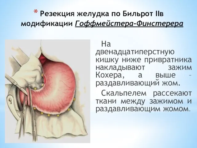 Резекция желудка по Бильрот IIв модификации Гоффмейстера-Финстерера На двенадцатиперстную кишку ниже привратника