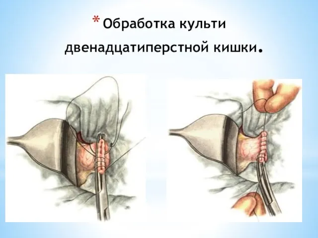 Обработка культи двенадцатиперстной кишки.