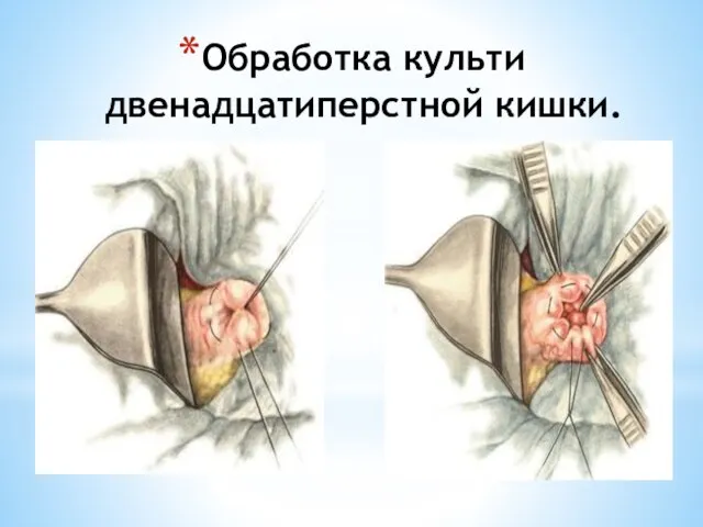 Обработка культи двенадцатиперстной кишки.