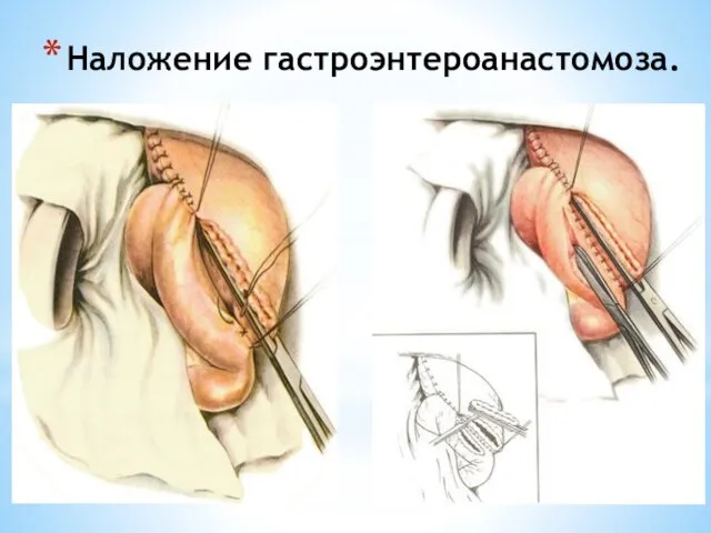 Наложение гастроэнтероанастомоза.