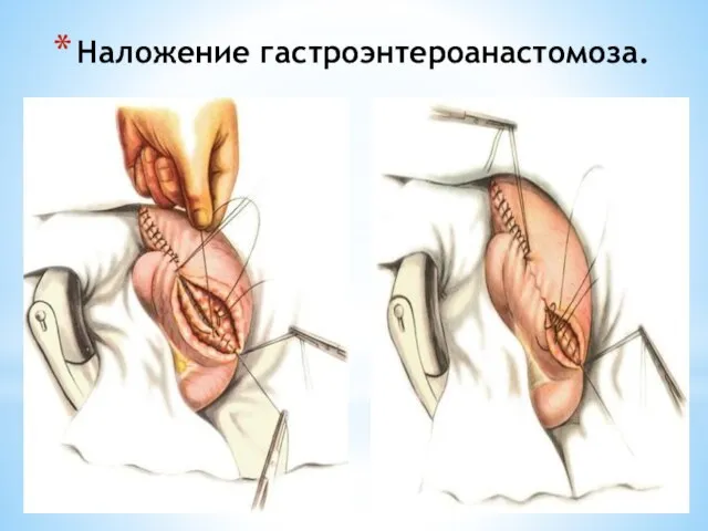 Наложение гастроэнтероанастомоза.