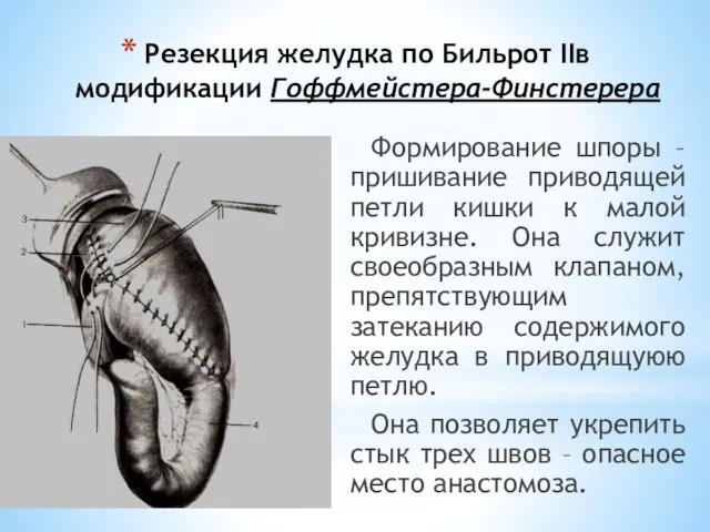 Резекция желудка по Бильрот IIв модификации Гоффмейстера-Финстерера Формирование шпоры – пришивание приводящей