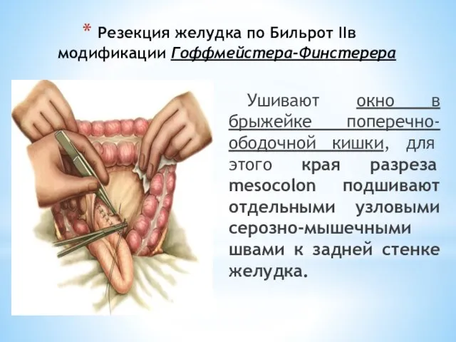 Резекция желудка по Бильрот IIв модификации Гоффмейстера-Финстерера Ушивают окно в брыжейке поперечно-ободочной