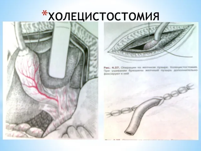 ХОЛЕЦИСТОСТОМИЯ