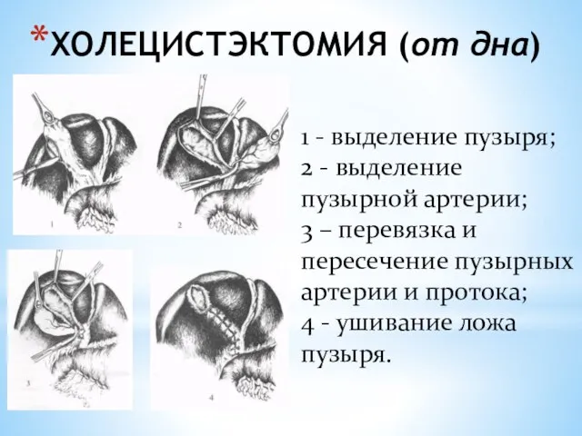 ХОЛЕЦИСТЭКТОМИЯ (от дна) 1 - выделение пузыря; 2 - выделение пузырной артерии;