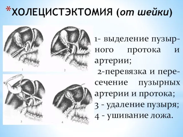 ХОЛЕЦИСТЭКТОМИЯ (от шейки) 1- выделение пузыр-ного протока и артерии; 2-перевязка и пере-сечение