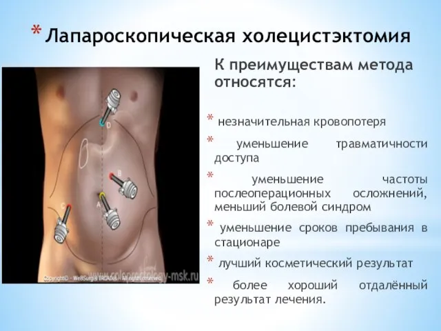 Лапароскопическая холецистэктомия К преимуществам метода относятся: незначительная кровопотеря уменьшение травматичности доступа уменьшение