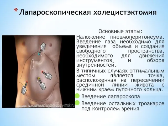 Лапароскопическая холецистэктомия Основные этапы: Наложение пневмоперитонеума. Введение газа необходимо для увеличения объема