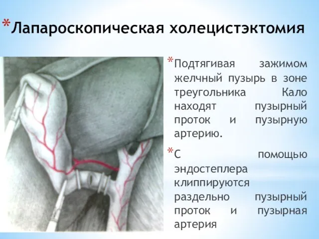 Лапароскопическая холецистэктомия Подтягивая зажимом желчный пузырь в зоне треугольника Кало находят пузырный