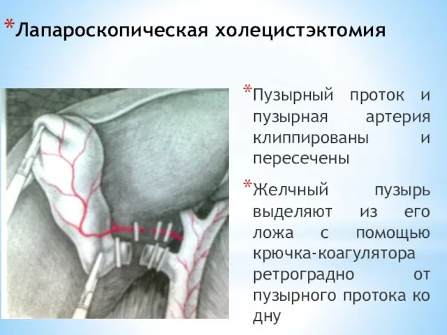 Лапароскопическая холецистэктомия Пузырный проток и пузырная артерия клиппированы и пересечены Желчный пузырь