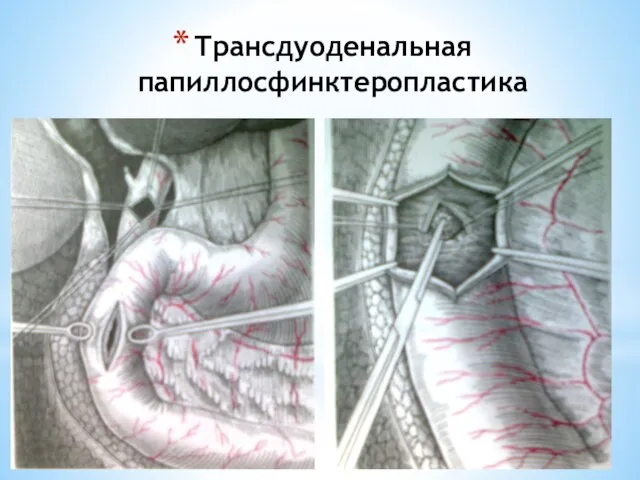 Трансдуоденальная папиллосфинктеропластика