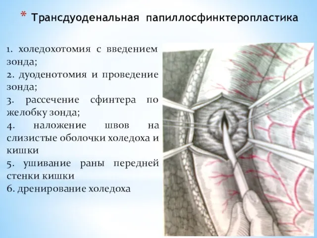 Трансдуоденальная папиллосфинктеропластика 1. холедохотомия с введением зонда; 2. дуоденотомия и проведение зонда;