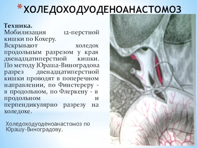 ХОЛЕДОХОДУОДЕНОАНАСТОМОЗ Холедоходуоденоанастомоз по Юрашу-Виноградову. Техника. Мобилизация 12-перстной кишки по Кохеру. Вскрывают холедох