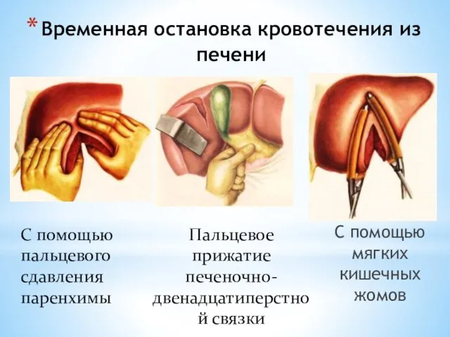 Временная остановка кровотечения из печени С помощью мягких кишечных жомов С помощью