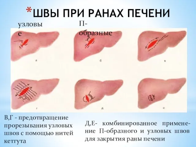 ШВЫ ПРИ РАНАХ ПЕЧЕНИ узловые П- образные В,Г - предотвращение прорезывания узловых