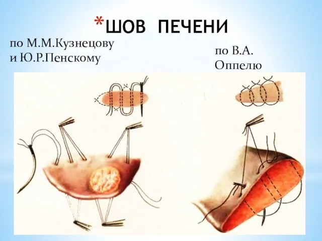 ШОВ ПЕЧЕНИ по В.А.Оппелю по М.М.Кузнецову и Ю.Р.Пенскому