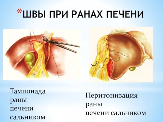 ШВЫ ПРИ РАНАХ ПЕЧЕНИ Тампонада раны печени сальником Перитонизация раны печени сальником