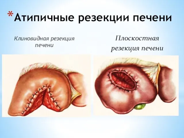 Атипичные резекции печени Клиновидная резекция печени Плоскостная резекция печени