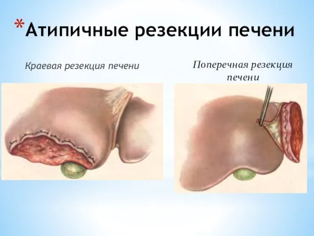 Атипичные резекции печени Краевая резекция печени Поперечная резекция печени