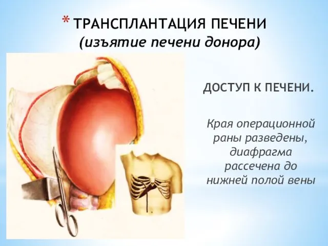 ТРАНСПЛАНТАЦИЯ ПЕЧЕНИ (изъятие печени донора) ДОСТУП К ПЕЧЕНИ. Края операционной раны разведены,