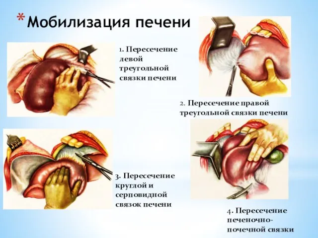 Мобилизация печени 1. Пересечение левой треугольной связки печени 2. Пересечение правой треугольной