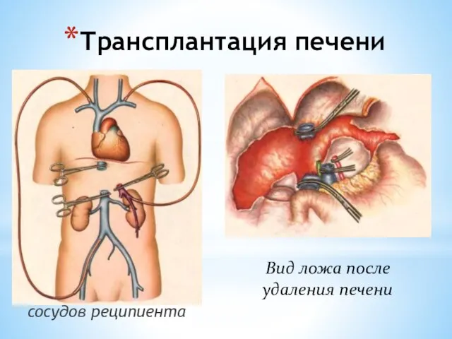 Трансплантация печени Схема шунтирования сосудов реципиента Вид ложа после удаления печени