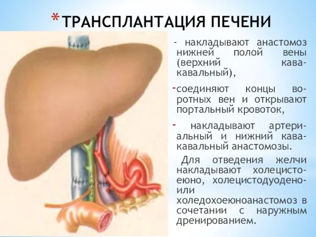 ТРАНСПЛАНТАЦИЯ ПЕЧЕНИ - накладывают анастомоз нижней полой вены (верхний кава-кавальный), соединяют концы