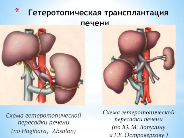 Гетеротопическая трансплантация печени Схема гетеротопической пересадки печени (по Hagihara, Absolon) Схема гетеротопической