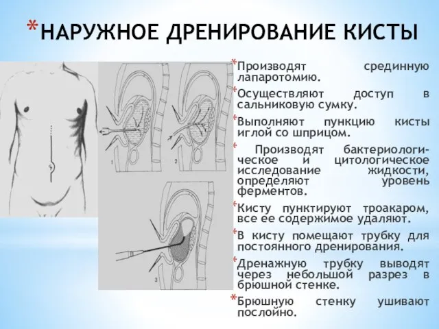 НАРУЖНОЕ ДРЕНИРОВАНИЕ КИСТЫ Производят срединную лапаротомию. Осуществляют доступ в сальниковую сумку. Выполняют