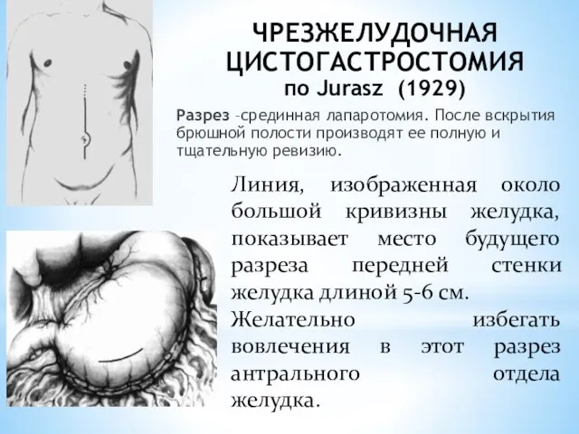 ЧРЕЗЖЕЛУДОЧНАЯ ЦИСТОГАСТРОСТОМИЯ по Jurasz (1929) Разрез –срединная лапаротомия. После вскрытия брюшной полости