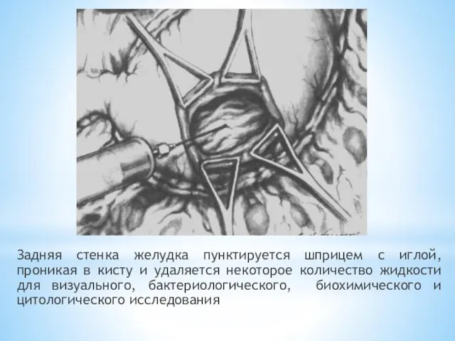 Задняя стенка желудка пунктируется шприцем с иглой, проникая в кисту и удаляется