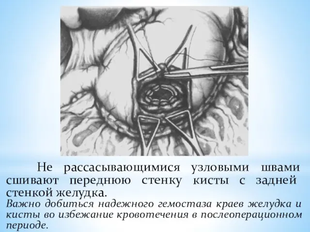 Не рассасывающимися узловыми швами сшивают переднюю стенку кисты с задней стенкой желудка.