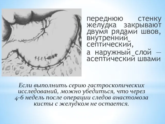 переднюю стенку желудка закрывают двумя рядами швов, внутренний септический, а наружный слой