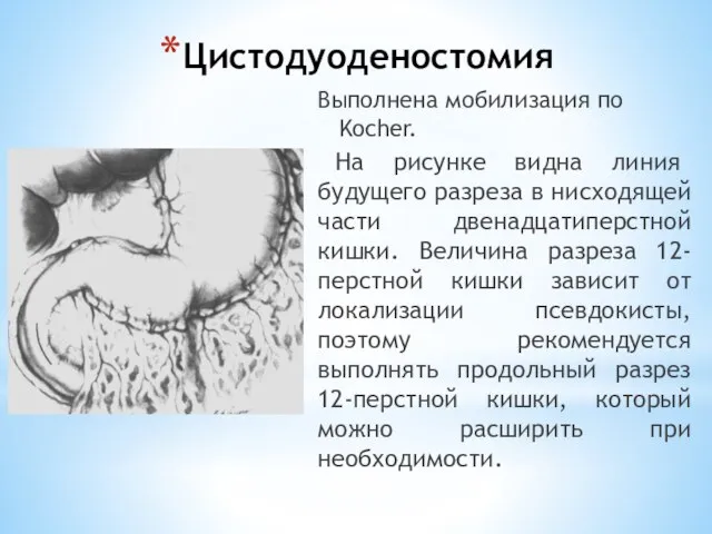 Цистодуоденостомия Выполнена мобилизация по Kocher. На рисунке видна линия будущего разреза в