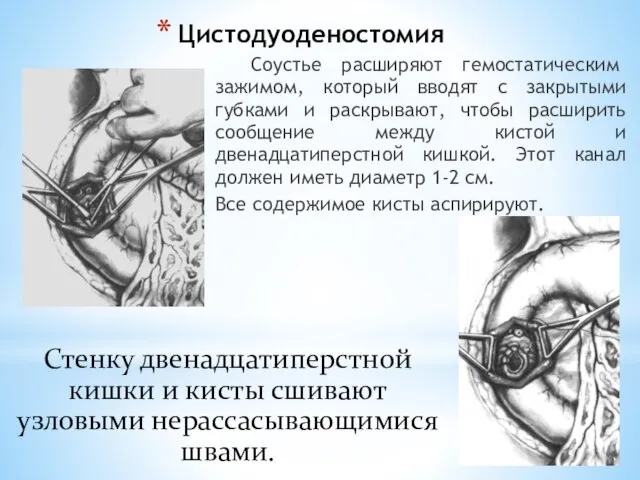 Цистодуоденостомия Соустье расширяют гемостатическим зажимом, который вводят с закрытыми губками и раскрывают,