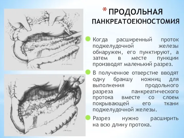 ПРОДОЛЬНАЯ ПАНКРЕАТОЕЮНОСТОМИЯ Когда расширенный проток поджелудочной железы обнаружен, его пунктируют, а затем