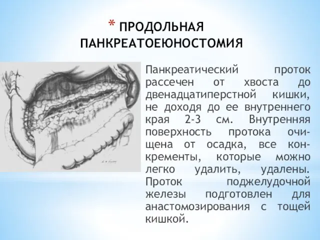 ПРОДОЛЬНАЯ ПАНКРЕАТОЕЮНОСТОМИЯ Панкреатический проток рассечен от хвоста до двенадцатиперстной кишки, не доходя