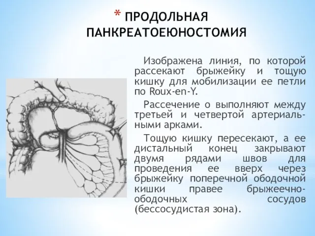 ПРОДОЛЬНАЯ ПАНКРЕАТОЕЮНОСТОМИЯ Изображена линия, по которой рассекают брыжейку и тощую кишку для