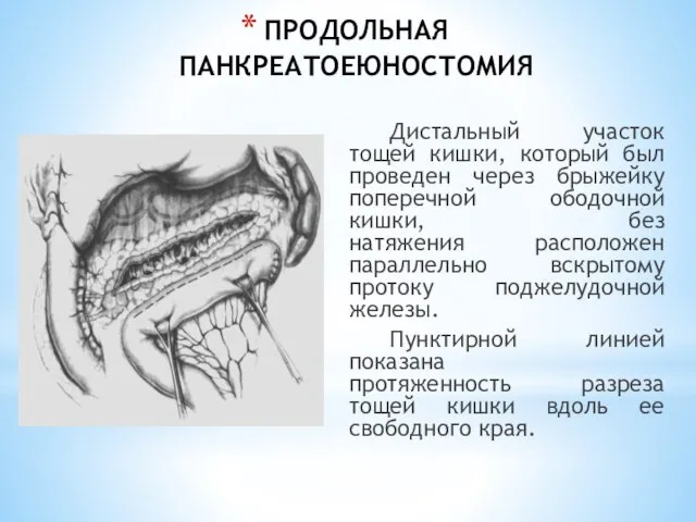 ПРОДОЛЬНАЯ ПАНКРЕАТОЕЮНОСТОМИЯ Дистальный участок тощей кишки, который был проведен через брыжейку поперечной