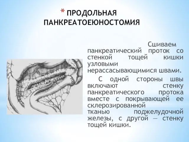 ПРОДОЛЬНАЯ ПАНКРЕАТОЕЮНОСТОМИЯ Сшиваем панкреатический проток со стенкой тощей кишки узловыми нерассасывающимися швами.