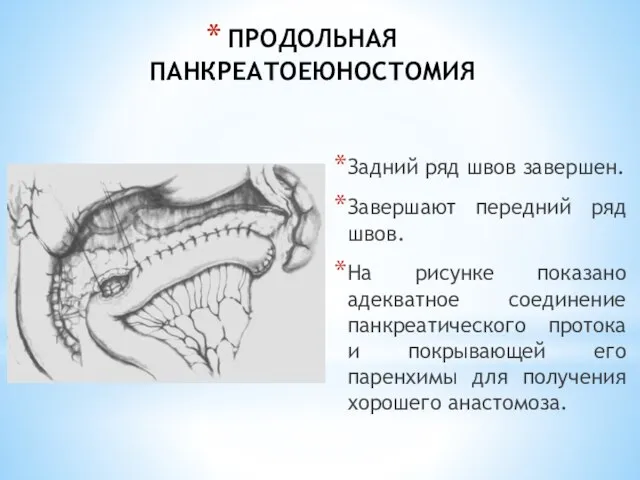 ПРОДОЛЬНАЯ ПАНКРЕАТОЕЮНОСТОМИЯ Задний ряд швов завершен. Завершают передний ряд швов. На рисунке