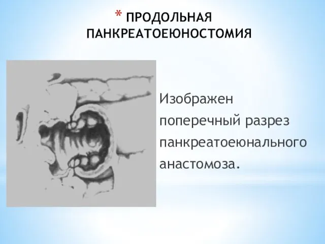 ПРОДОЛЬНАЯ ПАНКРЕАТОЕЮНОСТОМИЯ Изображен поперечный разрез панкреатоеюнального анастомоза.