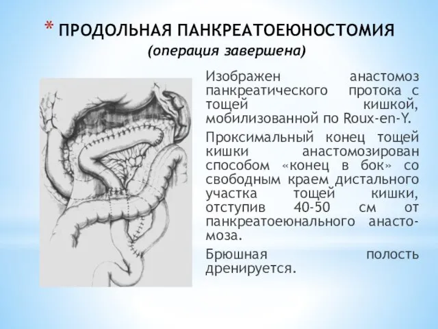 ПРОДОЛЬНАЯ ПАНКРЕАТОЕЮНОСТОМИЯ (операция завершена) Изображен анастомоз панкреатического протока с тощей кишкой, мобилизованной