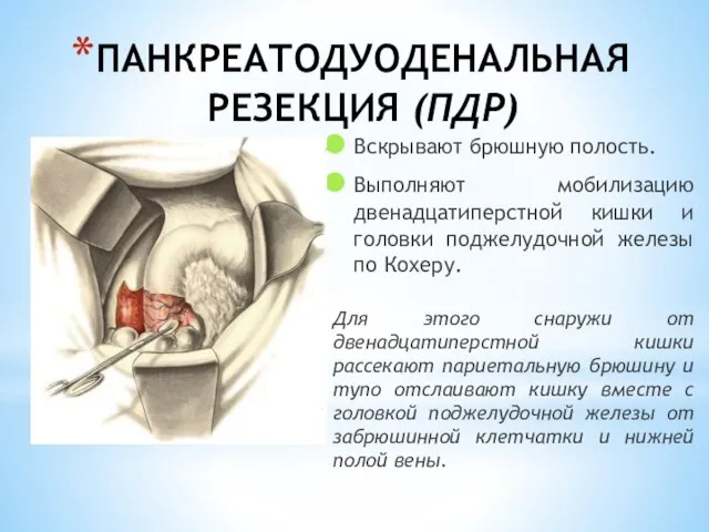 ПАНКРЕАТОДУОДЕНАЛЬНАЯ РЕЗЕКЦИЯ (ПДР) Вскрывают брюшную полость. Выполняют мобилизацию двенадцатиперстной кишки и головки