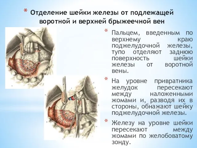 Отделение шейки железы от подлежащей воротной и верхней брыжеечной вен Пальцем, введенным