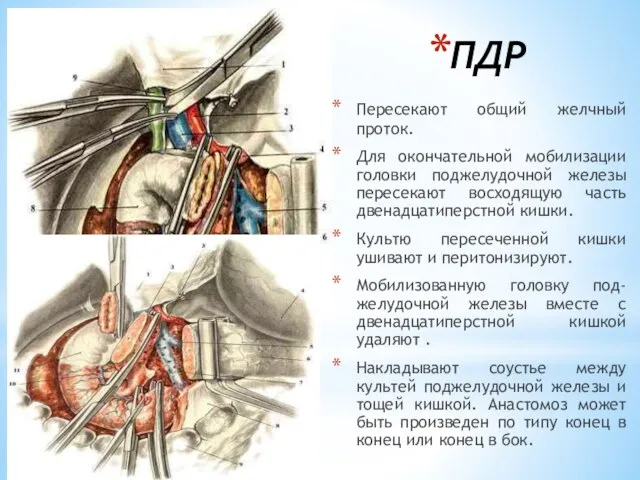 ПДР Пересекают общий желчный проток. Для окончательной мобилизации головки поджелудочной железы пересекают