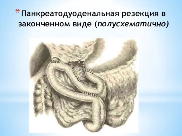 Панкреатодуоденальная резекция в законченном виде (полусхематично)