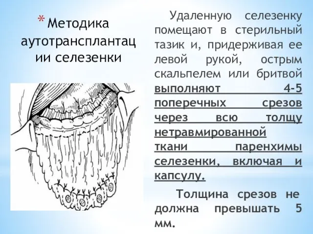 Методика аутотрансплантации селезенки Удаленную селезенку помещают в стерильный тазик и, придерживая ее