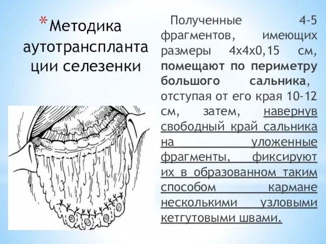 Методика аутотрансплантации селезенки Полученные 4-5 фрагментов, имеющих размеры 4x4x0,15 см, помещают по