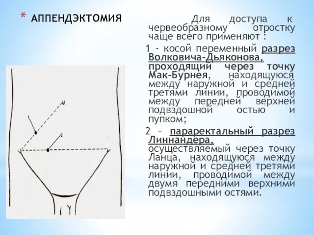 АППЕНДЭКТОМИЯ Для доступа к червеобразному отростку чаще всего применяют : 1 -